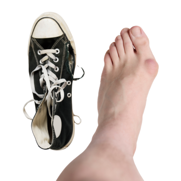 Vaivaisenluu on häiritsevä jalkaterään kohdistuva vaiva