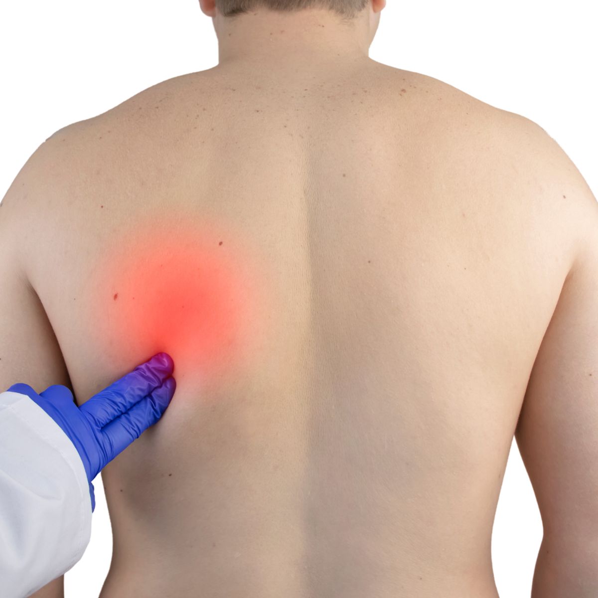 Kun lapaluu napsuu tai naksahtelee, kyseessä voi olla Snapping Scapula